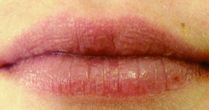 Lips after using ChopSaver