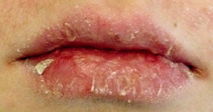 Chapped lips before using ChopSaver 