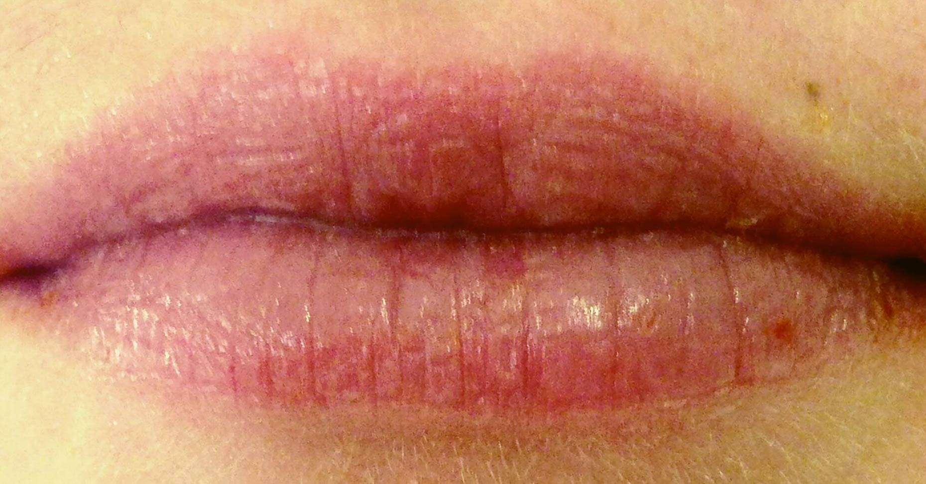 Healed-lips-1860x973-1.jpg